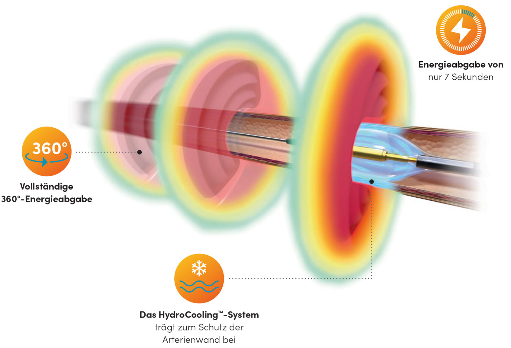 denervierung_mit_ultraschall_recor-medical