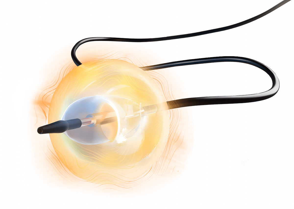 urdn-short-catheter-hero-w-sonication